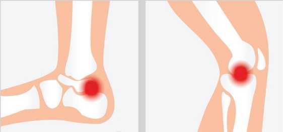 Карта при ревматоидном артрите
