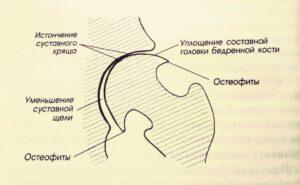 Схема лечения коксартроза тазобедренного сустава thumbnail